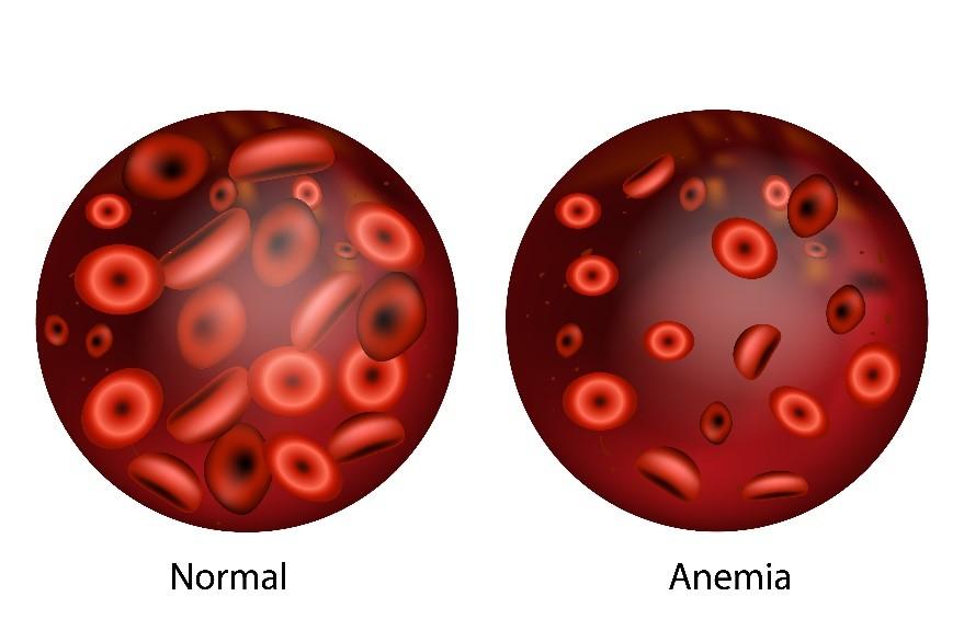 How Do I Know if I’m Anaemic? - Official Rapid Tests